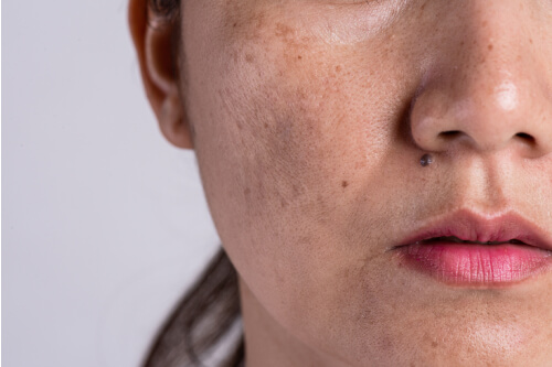 Melasma (paño)